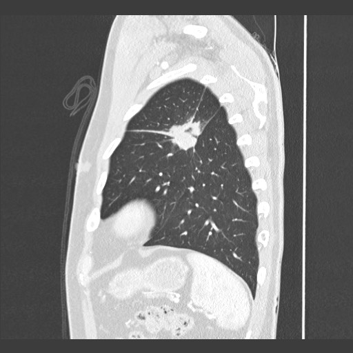 Adenocarcinoma of the lung (Radiopaedia 59871-67325 Sagittal lung window 84).jpg