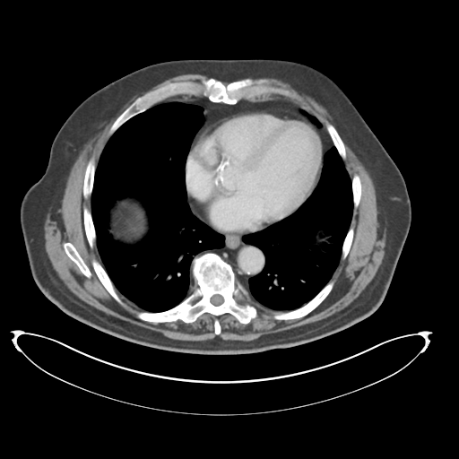File:Adenocarcioma of rectum- T1 lesion (Radiopaedia 36921-38547 Axial C+ portal venous phase 6).png