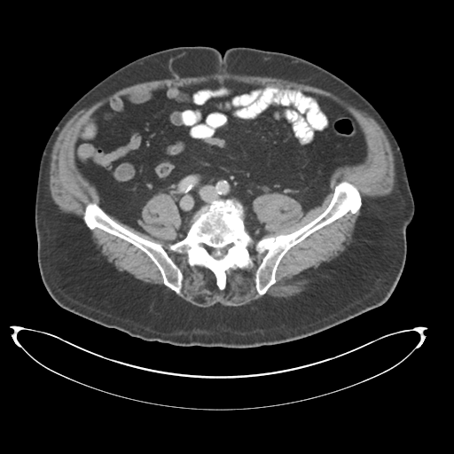 Adenocarcioma of rectum- T1 lesion (Radiopaedia 36921-38547 Axial C+ portal venous phase 61).png