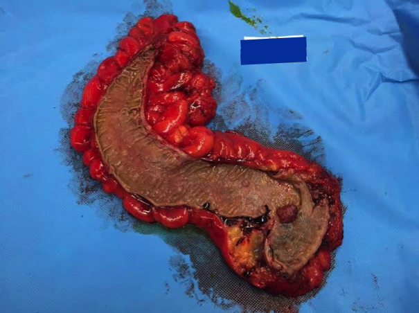 File:Adenocarcioma of rectum- T1 lesion (Radiopaedia 36921-38564 A 2).png