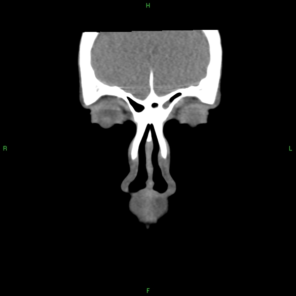 File:Adenoid cystic carcinoma of hard palate (Radiopaedia 26137-26273 Coronal liver window 1).jpg