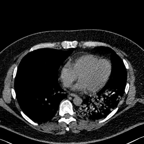 Adenoid cystic carcinoma of the trachea (Radiopaedia 49042-54137 Axial non-contrast 232).jpg