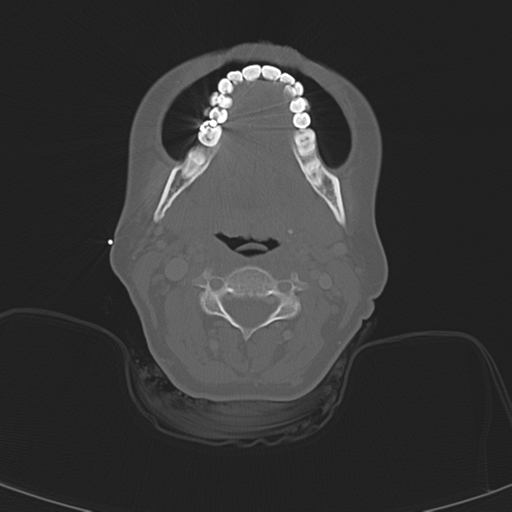 File:Adenoid cystic tumor of palate (Radiopaedia 46980-51518 Axial bone window 37).png