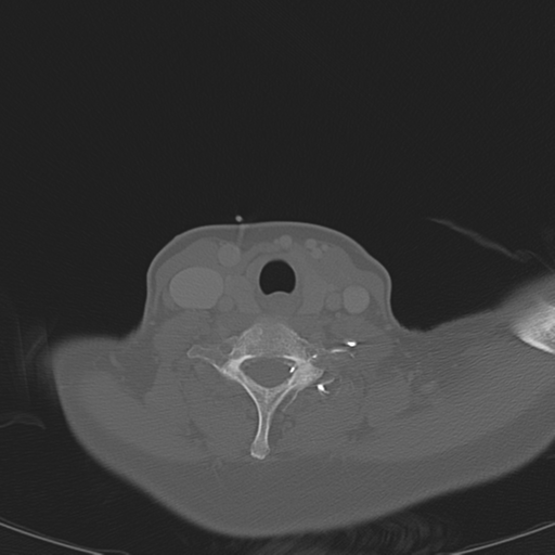 File:Adenoid cystic tumor of palate (Radiopaedia 46980-51518 Axial bone window 56).png