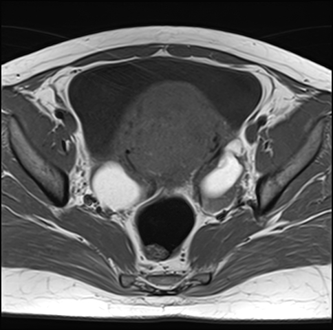 File:Adenomyosis - ovarian endometriomas (Radiopaedia 67031-76350 Axial T1 15).jpg