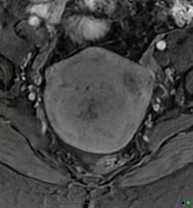 Adenomyosis uterus with hematometra (Radiopaedia 45779-50011 Axial T1 C+ fat sat 22).jpg