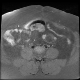 File:Adenomyosis within a didelphys uterus (Radiopaedia 70175-80215 Axial T1 fat sat 10).jpg