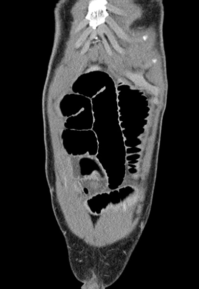 Adhesional small bowel obstruction (Radiopaedia 52107-57980 Coronal C+ portal venous phase 9).jpg
