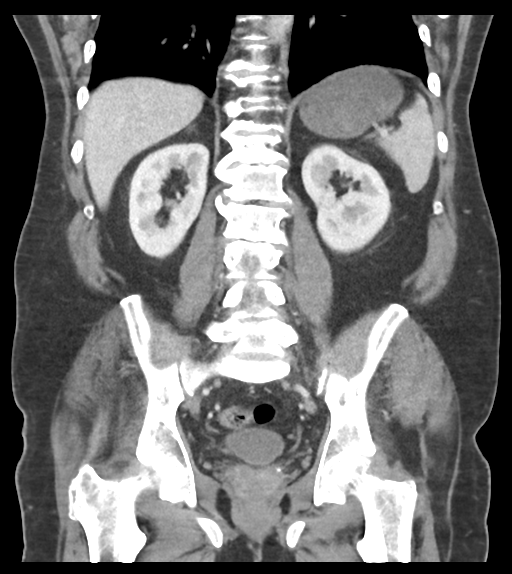 Adhesions within abdominal wall hernia (Radiopaedia 58283-65394 Coronal C+ portal venous phase 48).png