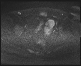 Adnexal multilocular cyst (O-RADS US 3- O-RADS MRI 3) (Radiopaedia 87426-103754 Axial DWI 74).jpg