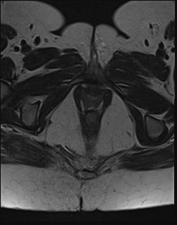 File:Adnexal multilocular cyst (O-RADS US 3- O-RADS MRI 3) (Radiopaedia 87426-103754 Axial T2 25).jpg