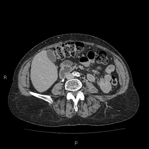 File:Adrenal collision tumor (ACT) (Radiopaedia 48462-53379 Axial C+ delayed 37).jpg