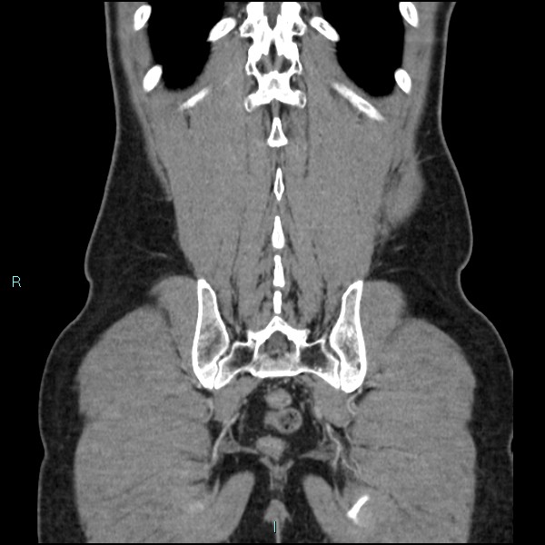 File:Adrenal cystic lymphangioma (Radiopaedia 83161-97534 Coronal C+ portal venous phase 65).jpg