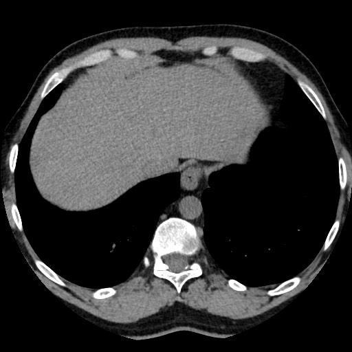 Adrenal gland trauma (Radiopaedia 81351-95079 Axial non-contrast 13).jpg