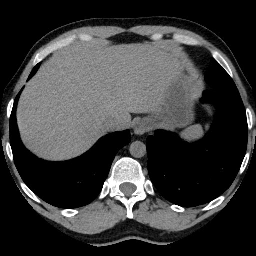 Adrenal gland trauma (Radiopaedia 81351-95079 Axial non-contrast 15).jpg