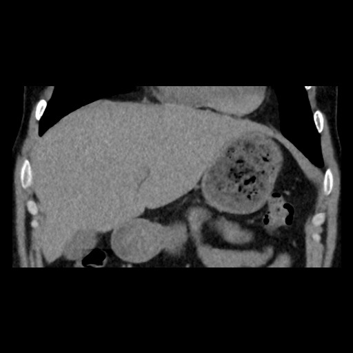 Adrenal gland trauma (Radiopaedia 81351-95079 Coronal non-contrast 29).jpg