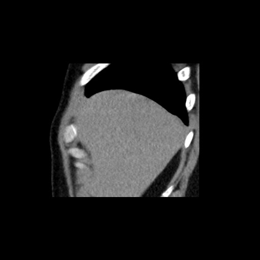 File:Adrenal gland trauma (Radiopaedia 81351-95079 Sagittal non-contrast 11).jpg