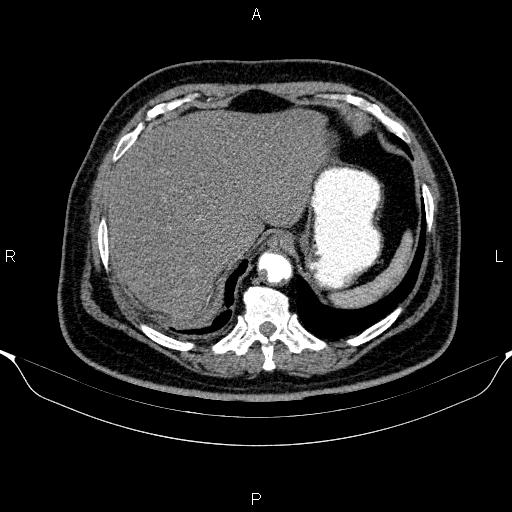 Adrenal hemorrhage (Radiopaedia 62622-70916 Axial C+ arterial phase 49).jpg