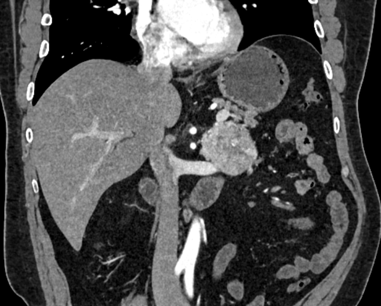 Adrenal metastases (Radiopaedia 73082-83791 Coronal C+ arterial phase 15).jpg