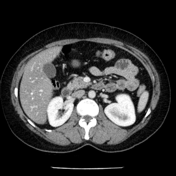 Adrenal myelolipoma (Radiopaedia 43401-46759 Axial C+ portal venous phase 33).jpg