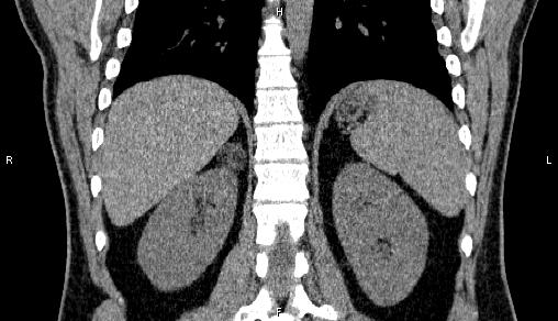Adrenal myelolipoma (Radiopaedia 84321-99619 Coronal non-contrast 57).jpg