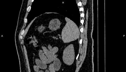 File:Adrenal myelolipoma (Radiopaedia 84321-99619 Sagittal non-contrast 88).jpg