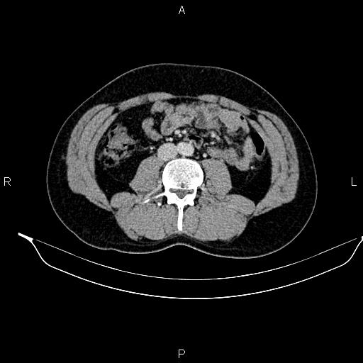 Adrenal myelolipoma (Radiopaedia 87794-104246 Axial renal cortical phase 58).jpg