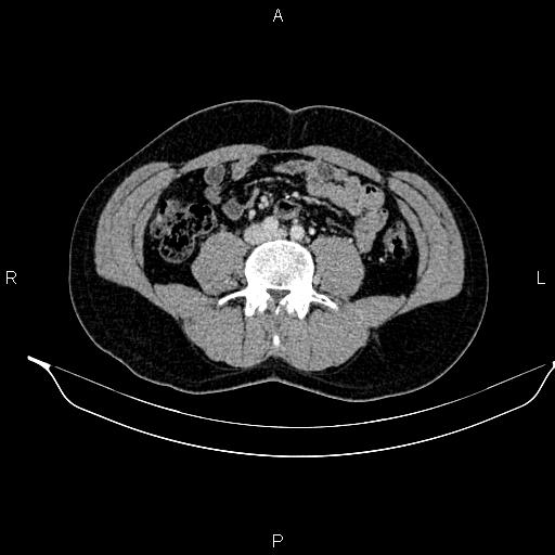 Adrenal myelolipoma (Radiopaedia 87794-104246 Axial renal cortical phase 64).jpg