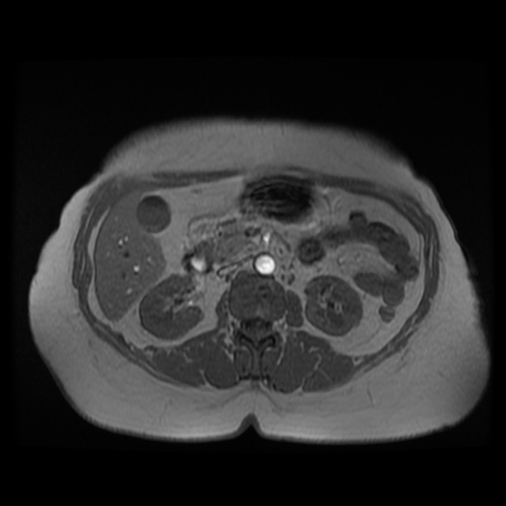 File:Adrenal myelolipoma - MRI (Radiopaedia 83249-97646 Axial T1-in phase 16).jpg