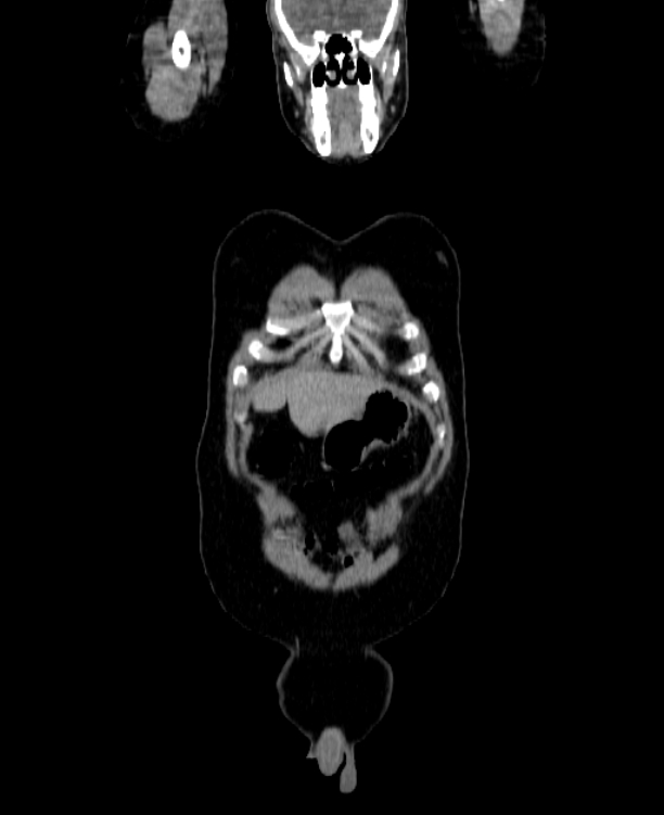 Adrenocortical carcinoma (Radiopaedia 80134-93438 Coronal C+ portal venous phase 23).jpg