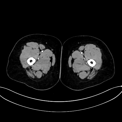 Adrenocortical carcinoma (Radiopaedia 87281-103569 Axial C+ arterial phase 105).jpg