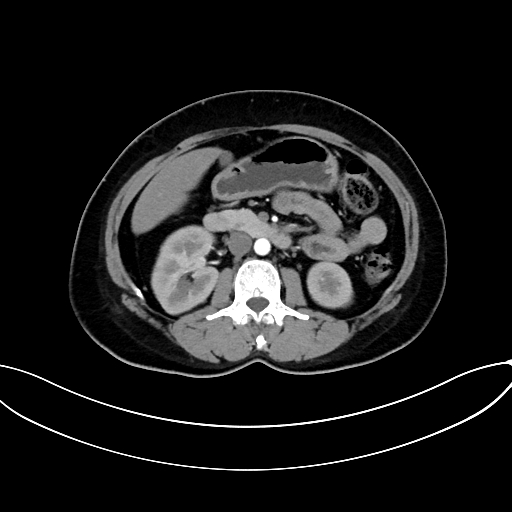 Adrenocortical carcinoma (Radiopaedia 87281-103569 Axial C+ arterial phase 40).jpg