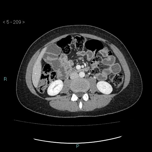 Adult transient intestinal intussusception (Radiopaedia 34853-36310 Axial C+ portal venous phase 39).jpg
