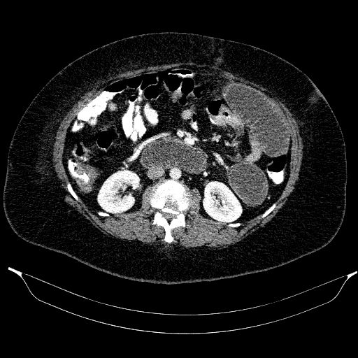 Afferent loop syndrome - secondary to incarcerated trocar site hernia (Radiopaedia 82959-97305 Axial C+ portal venous phase 107).jpg