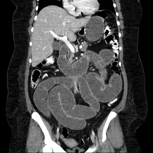 File:Afferent loop syndrome - secondary to incarcerated trocar site hernia (Radiopaedia 82959-97305 Coronal C+ portal venous phase 78).jpg