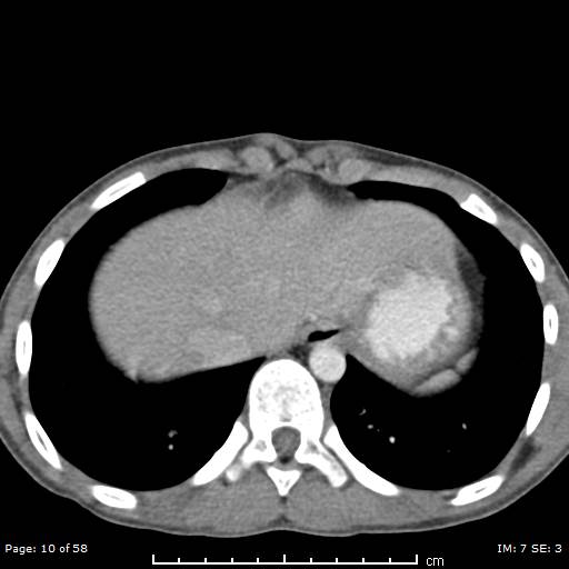 File:Agenesis of the gallbladder (Radiopaedia 55454-61905 Axial 41).jpg