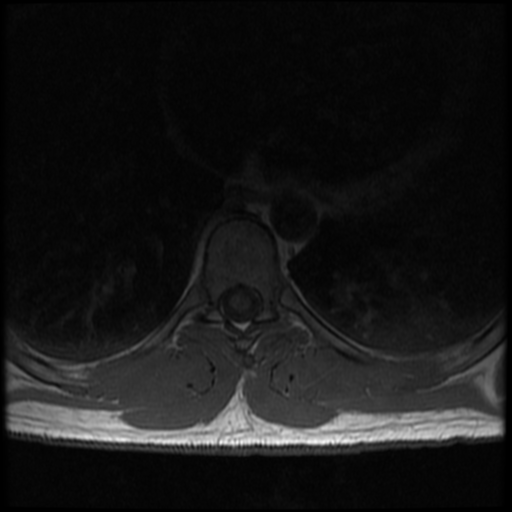 File:Aggressive vertebral hemangioma (Radiopaedia 39937-42404 Axial T1 17).png