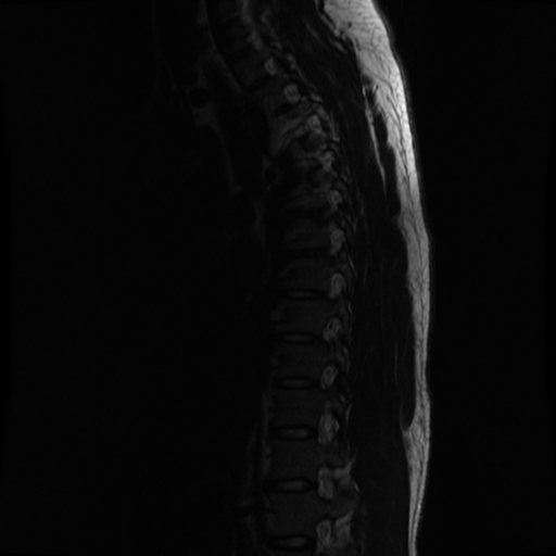File:Aggressive vertebral hemangioma (Radiopaedia 39937-42404 Sagittal T2 11).png
