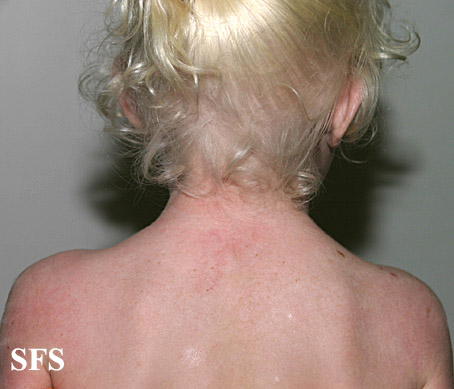 Albinism (Dermatology Atlas 3).jpg