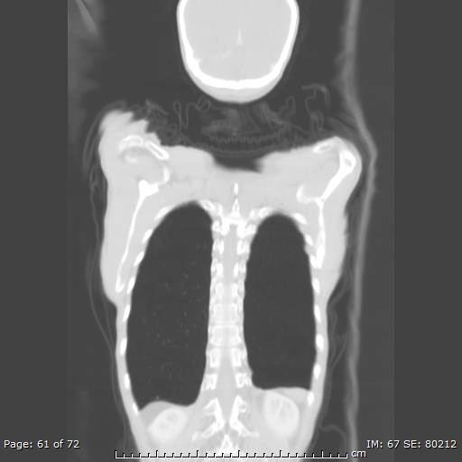 Alpha-1-antitrypsin deficiency (Radiopaedia 50561-55987 Coronal lung window 59).jpg