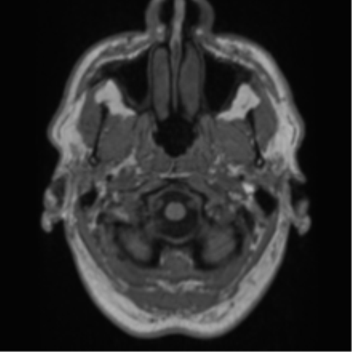 Alzheimer's disease- with Gerstmann syndrome and dressing apraxia (Radiopaedia 54882-61150 Axial T1 4).png