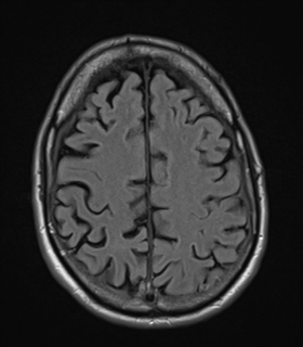File:Alzheimer's disease- with apraxia (Radiopaedia 54763-61011 Axial FLAIR 21).png