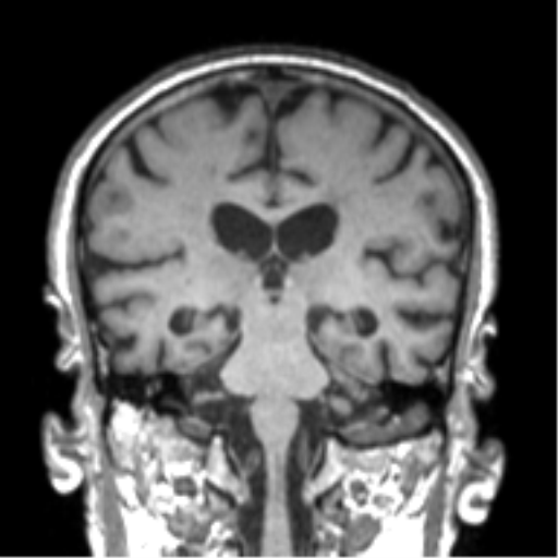 File:Alzheimer disease and cerebral amyloid angiopathy (Radiopaedia 64234-73011 Coronal T1 26).png