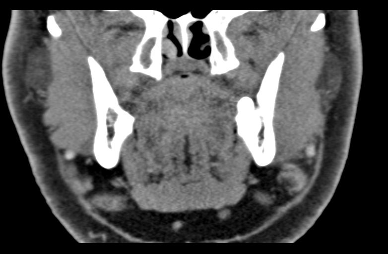 Ameloblastoma (Radiopaedia 33677-34806 Coronal non-contrast 30).png