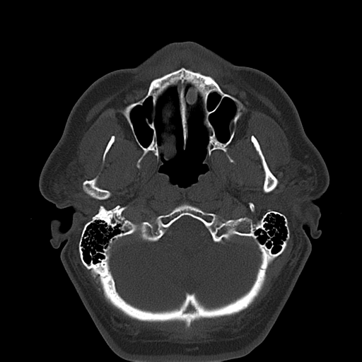 Ameloblastoma (Radiopaedia 38520-40623 Axial bone window 18).png