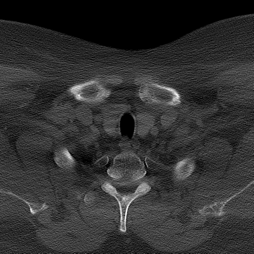 Ameloblastoma (Radiopaedia 38520-40623 Axial bone window 72).png
