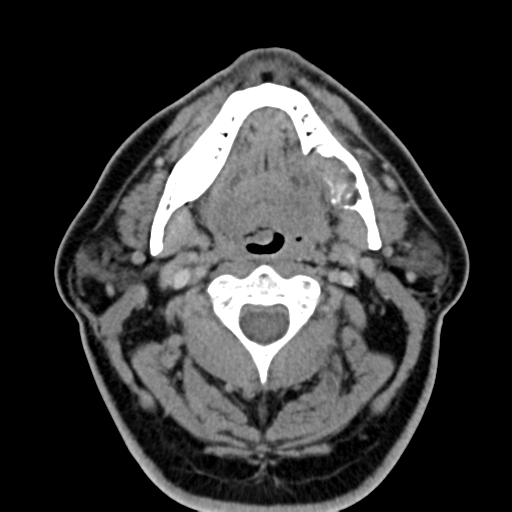 Ameloblastoma (Radiopaedia 38520-40623 Axial non-contrast 31).png