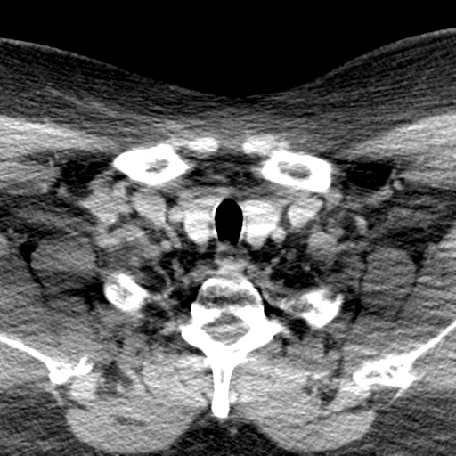 File:Ameloblastoma (Radiopaedia 38520-40623 Axial non-contrast 71).png