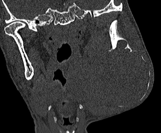 Ameloblastoma (Radiopaedia 51921-57766 Coronal bone window 170).jpg