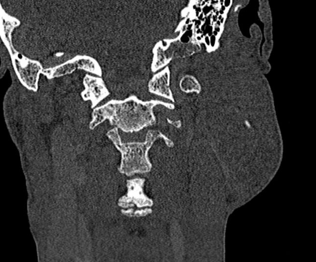 Ameloblastoma (Radiopaedia 51921-57766 Coronal bone window 231).jpg